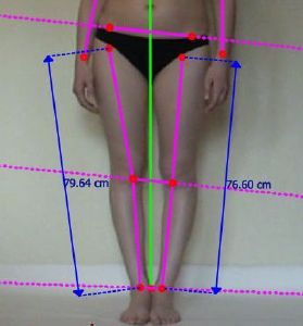 Bilan postural difference de membre inferieur orthoposturie