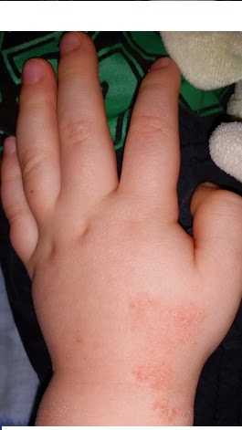 Eczema 3