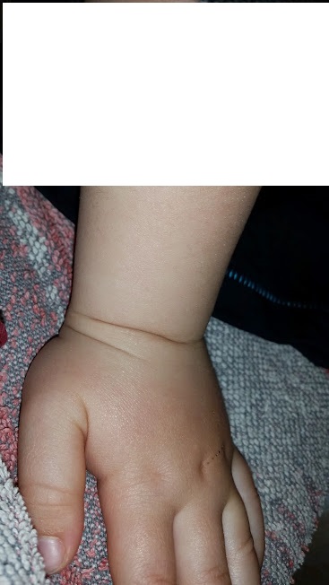 Eczema 1