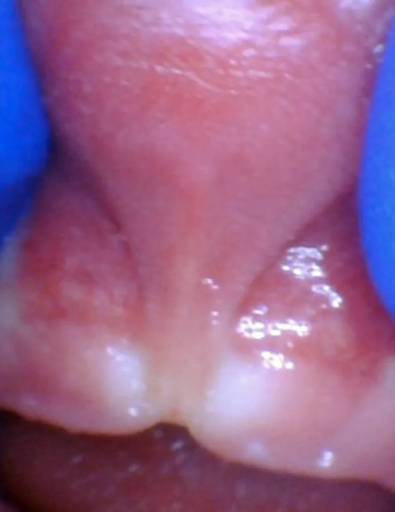 Release tongue ties laser technology tongue ties infant lip tie 2