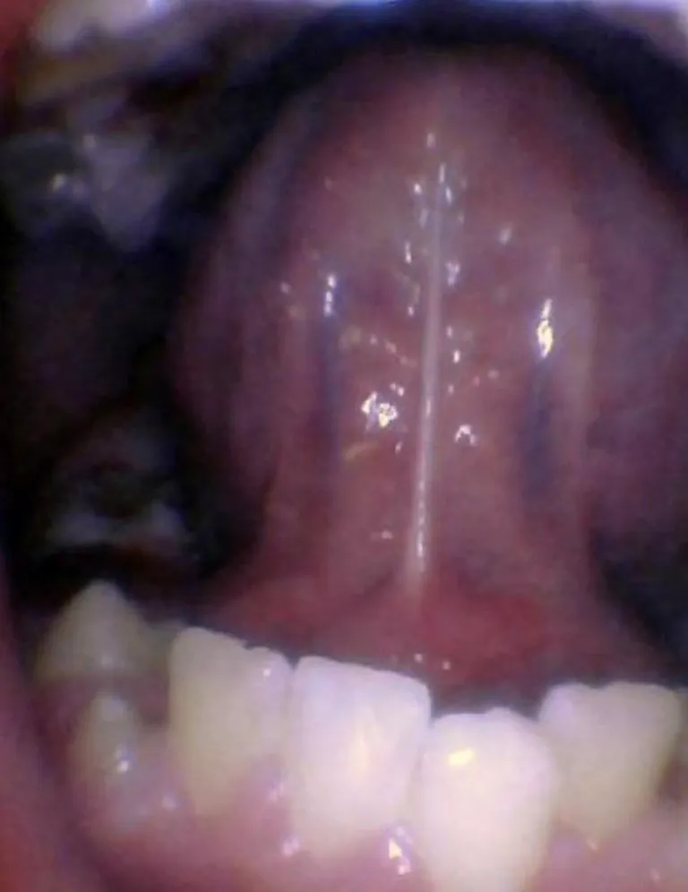 Release tongue ties laser technology tongue ties child tongue tie 4