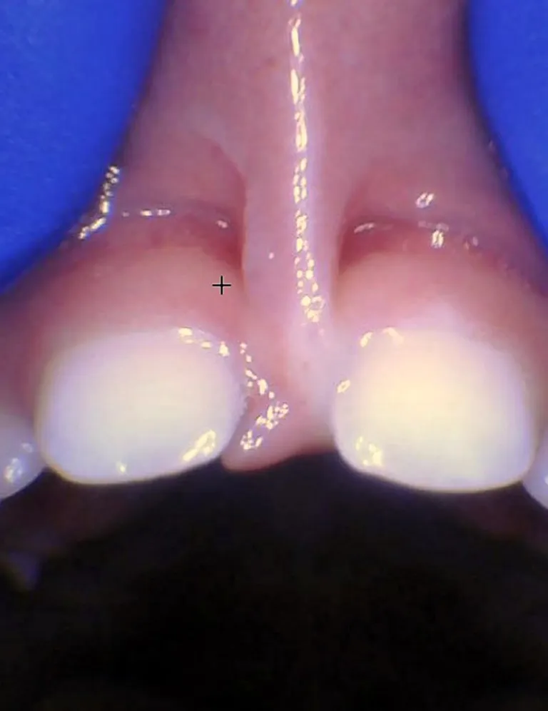Release tongue ties laser technology tongue ties child lip tie 3