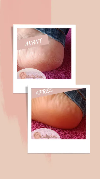 Instant Foot Peeling