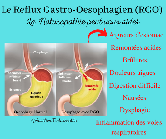 Reflux-gastro-oesophagien