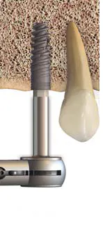 Implant4