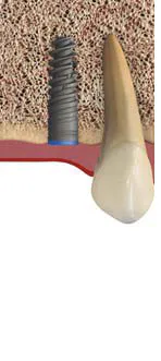 Implant5