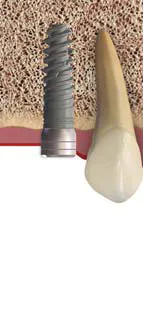 Implant6