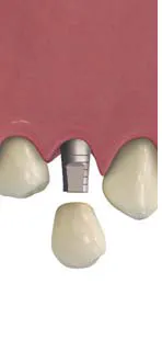 Implant7