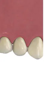 Implant8