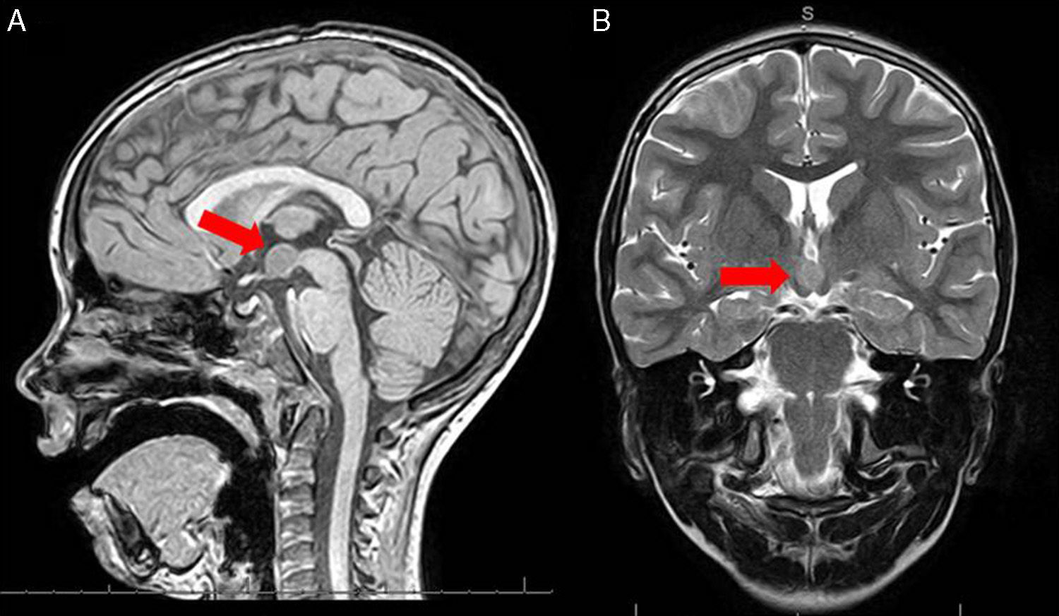 Hamartome-hypothalamique-2