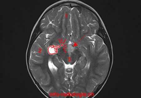 Hamartome-hypothalamique-tmb1