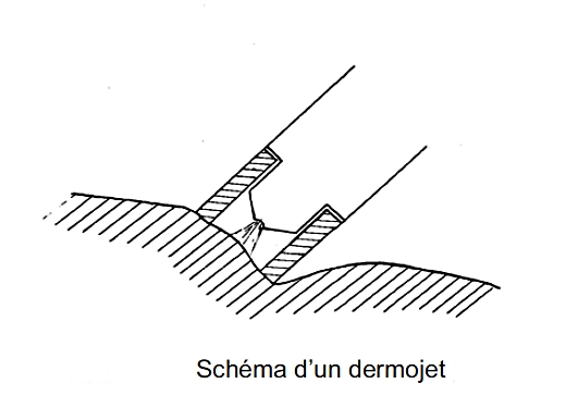 Dermojet