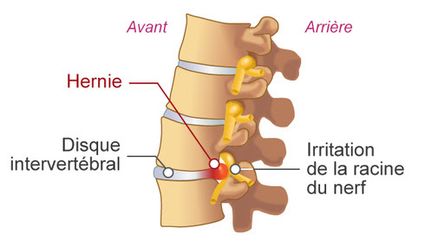 Hernie discale vertebrale