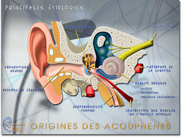 Acouphenes origines