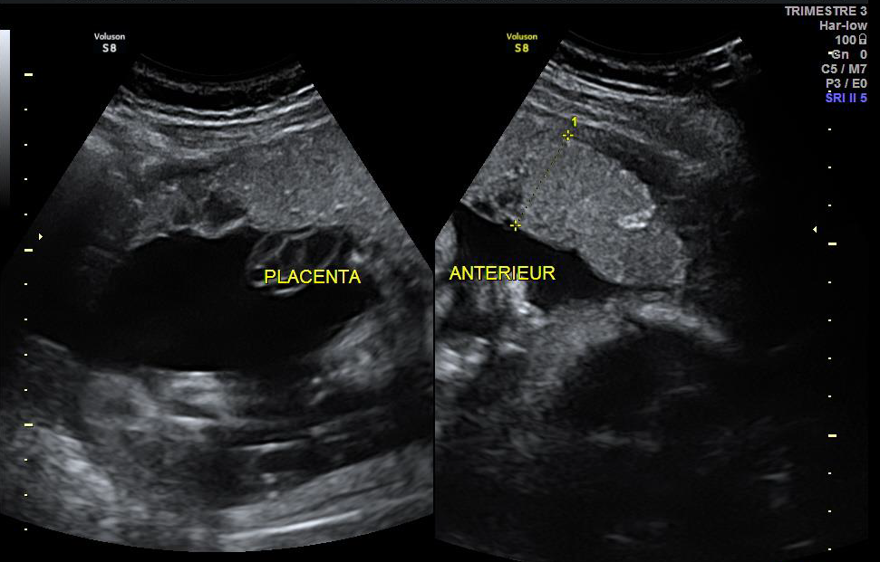Placenta