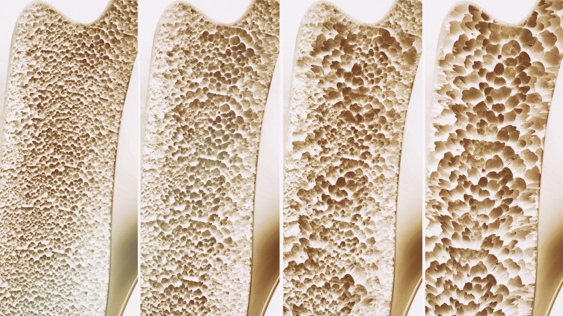 Osteoporosis stages