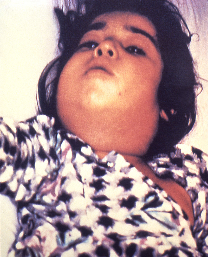 800px Diphtheria bull neck 5325 lores