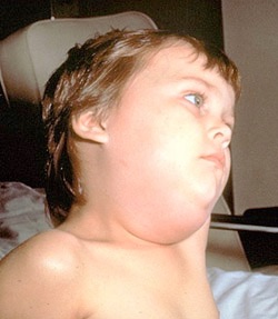 Mumps