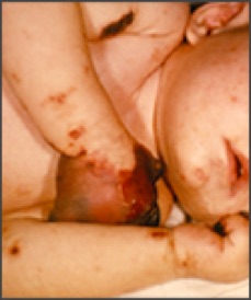 People meningococcal5