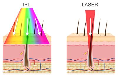 Laser hair removal graphic IPLvsLaser