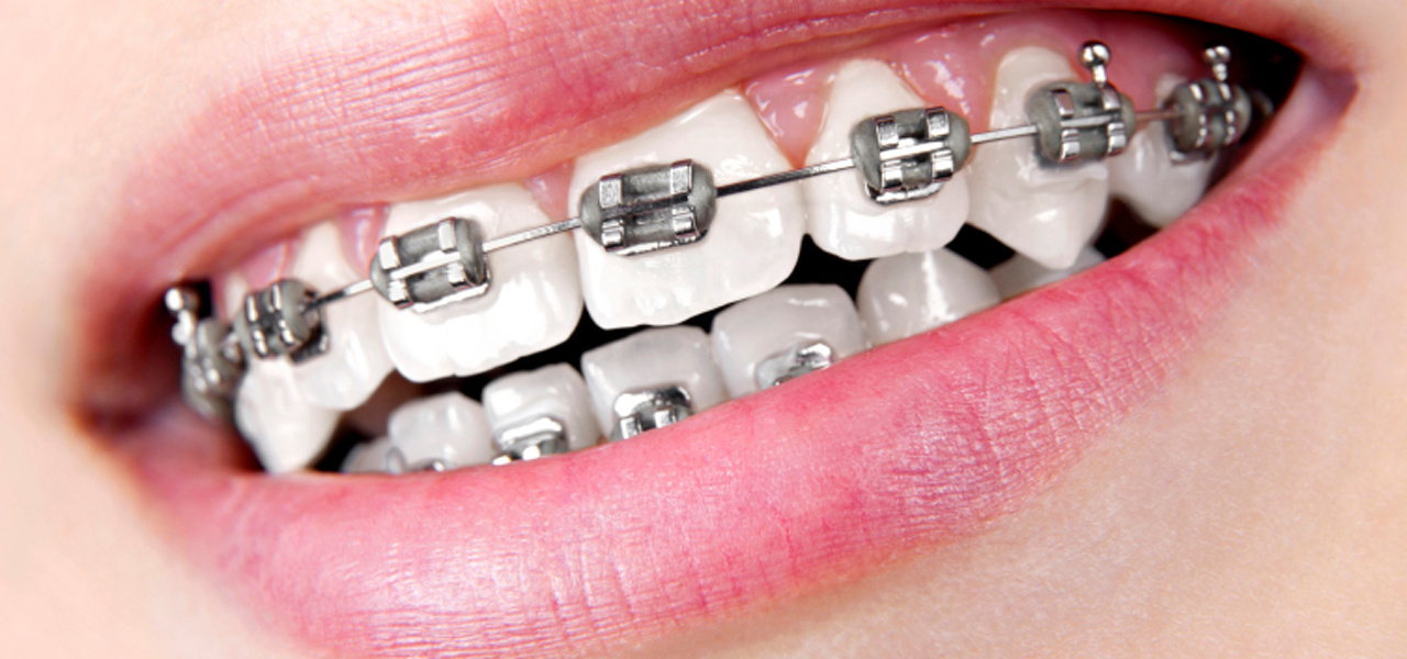 Brackets metalicos2 1280x600