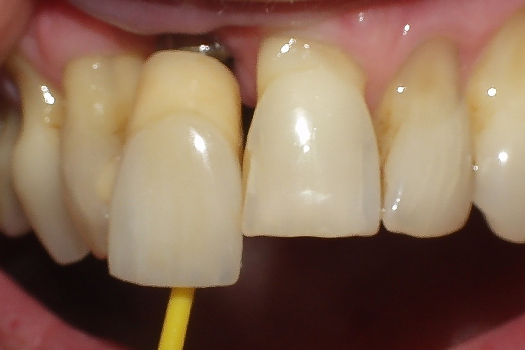 Laboratoire de prothèse dentaire Dollé Céfaï dent travaux ceramique
