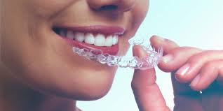 Images ortho invasilign