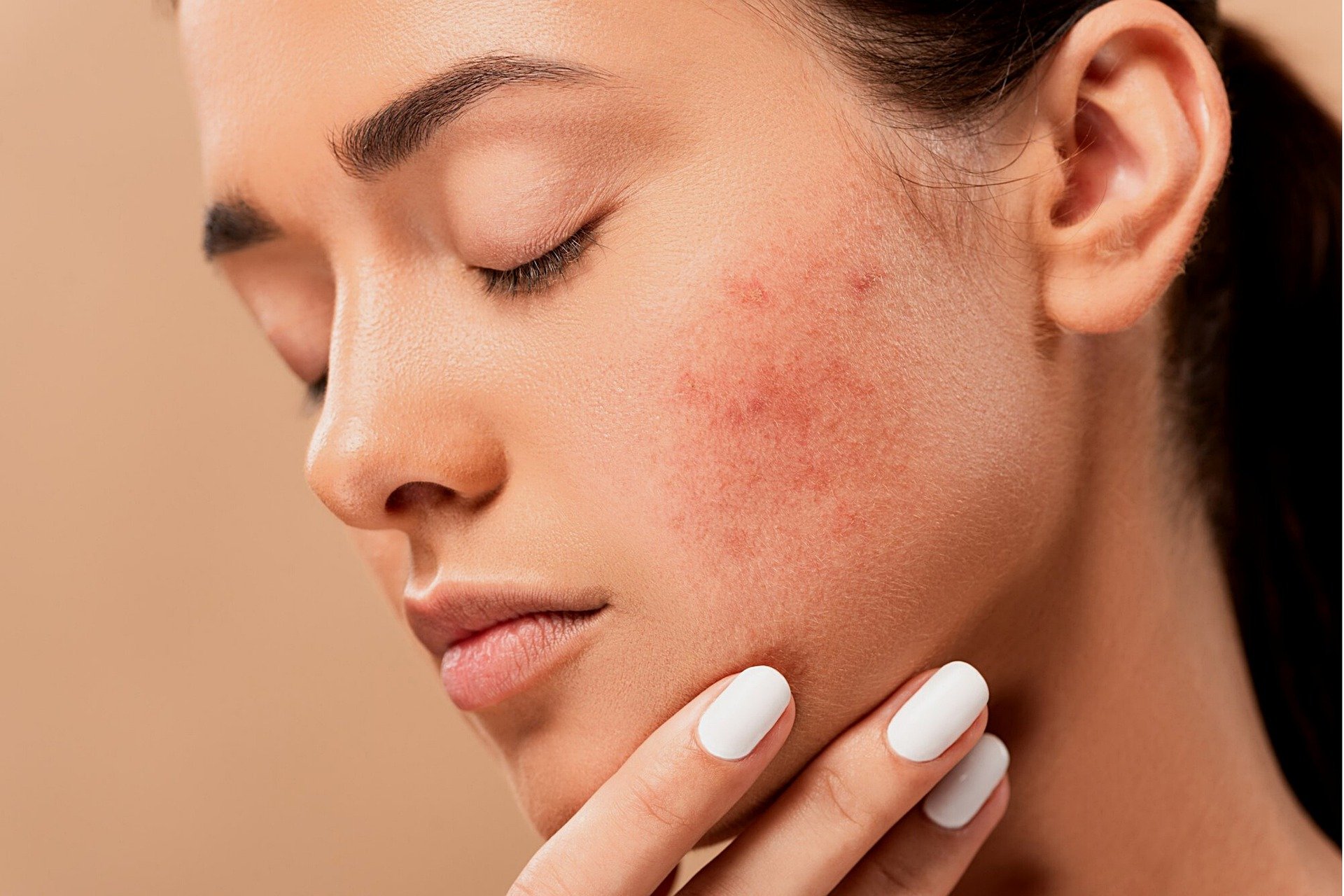 Le praticien Cécile Chabot Lyon Acupuncture propose des séances d'accupuncture efficaces pour les problèmes de peau, tels que l'acnée et l'eczéma.