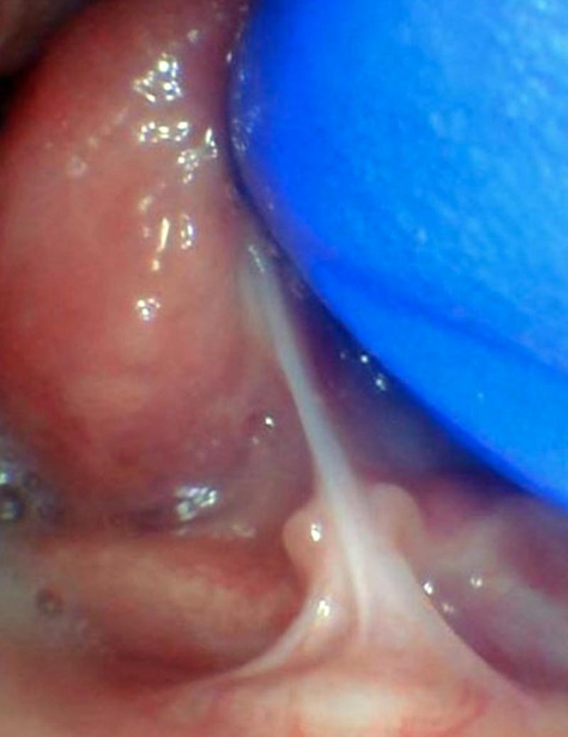 Release tongue ties laser technology tongue ties infant tongue tie 3