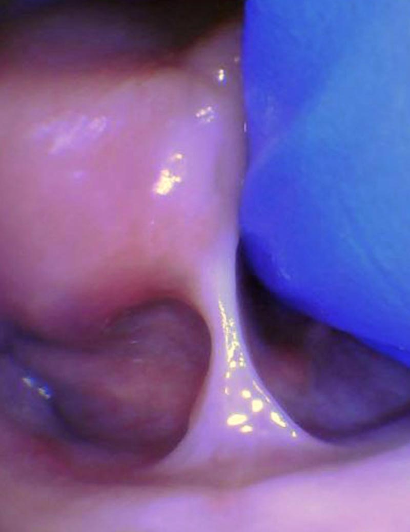 Release tongue ties laser technology tongue ties infant tongue tie 2
