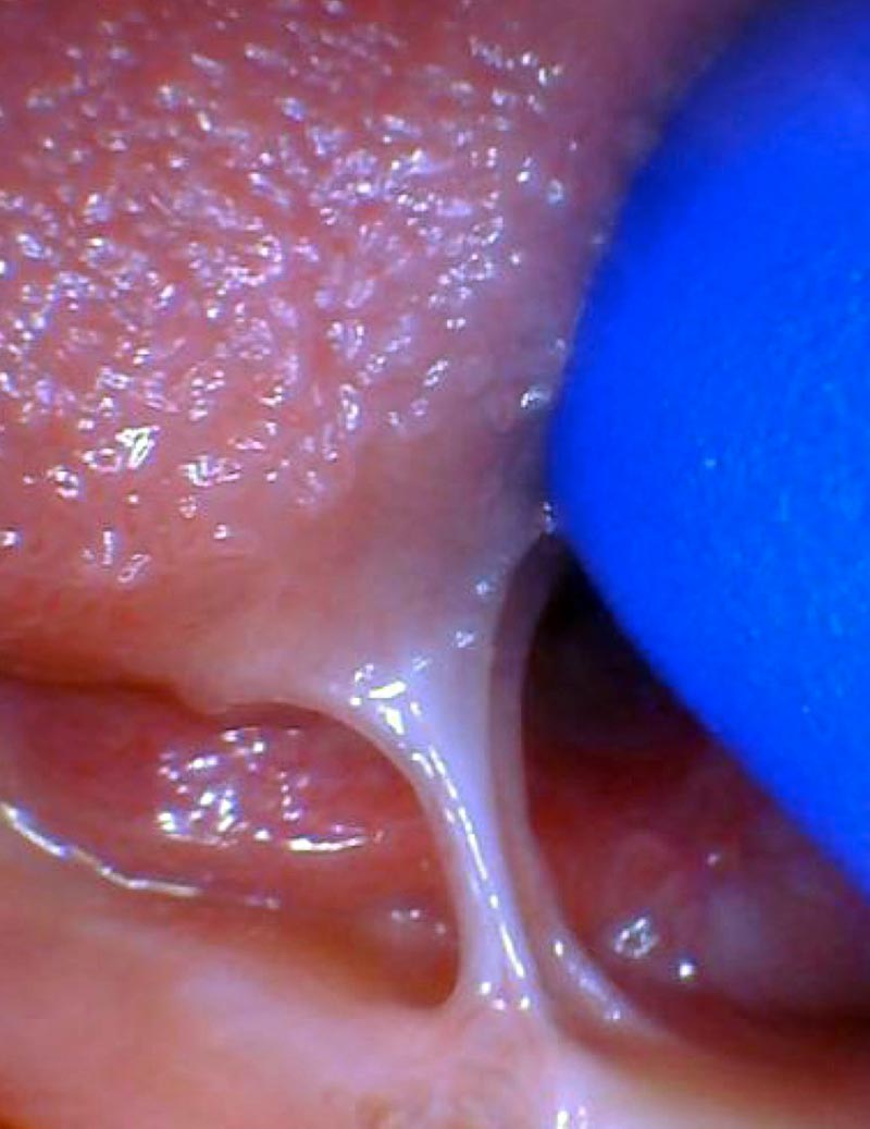 Release tongue ties laser technology tongue ties infant tongue tie 1