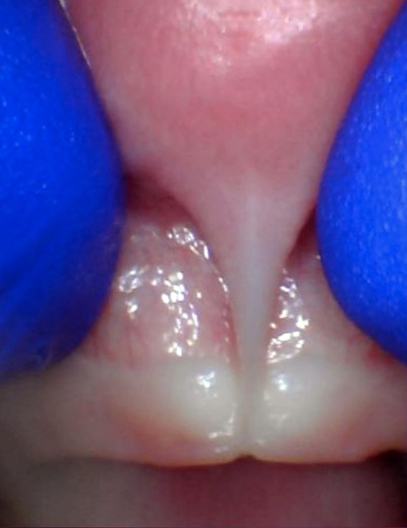 Release tongue ties laser technology tongue ties infant lip tie 4