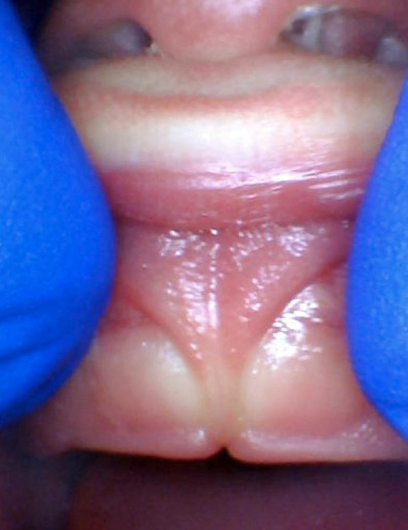 Release tongue ties laser technology tongue ties infant lip tie 3