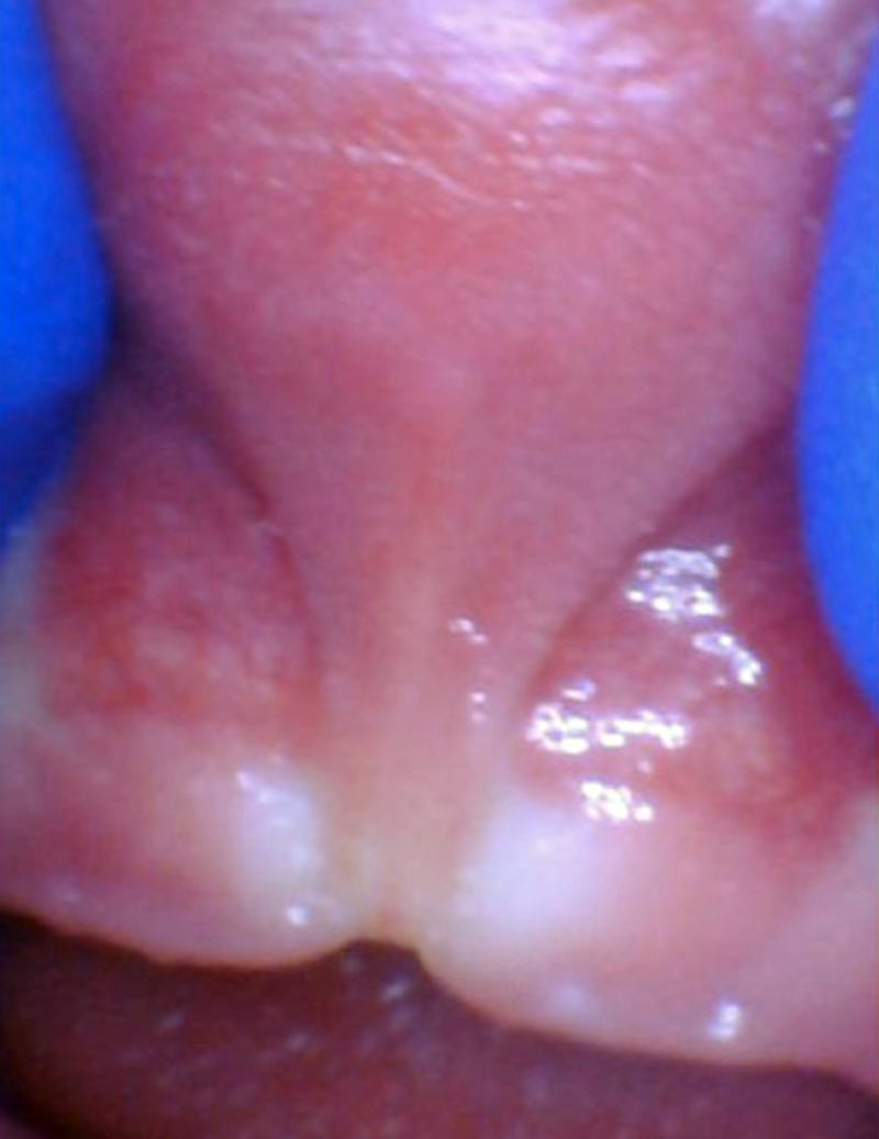 Release tongue ties laser technology tongue ties infant lip tie 2