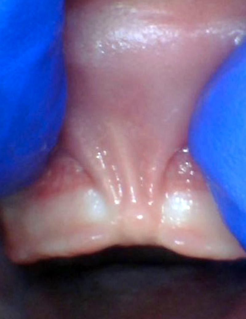 Release tongue ties laser technology tongue ties infant lip tie 1