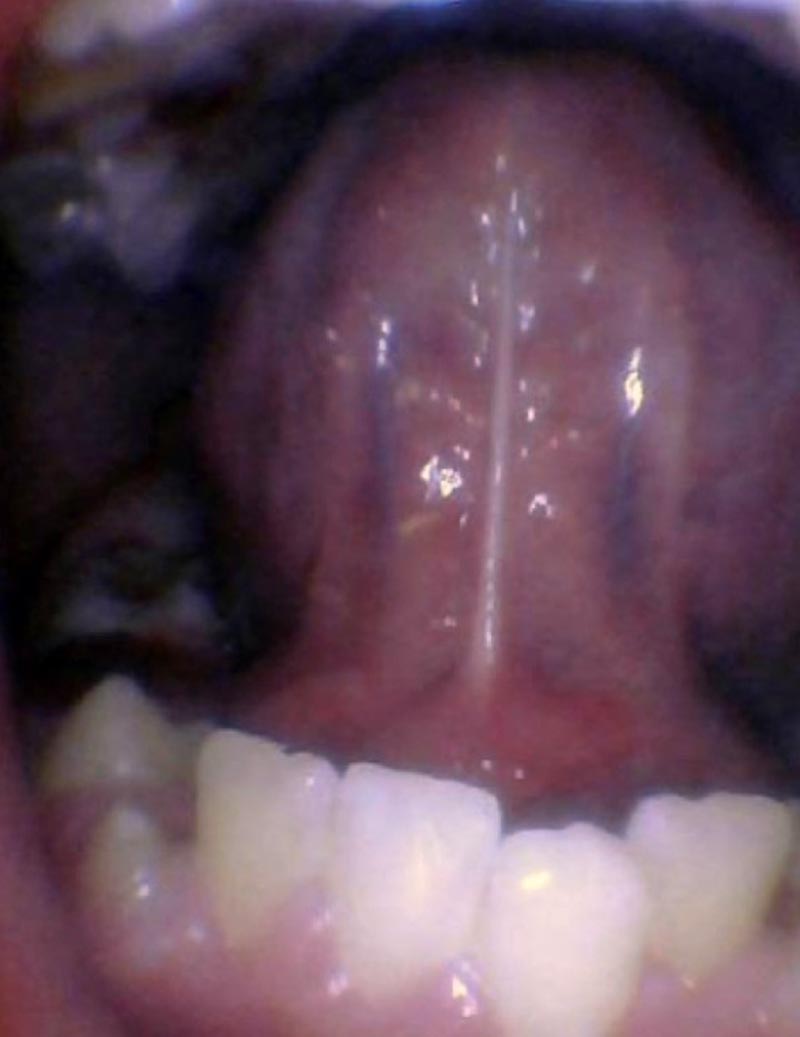 Release tongue ties laser technology tongue ties child tongue tie 4