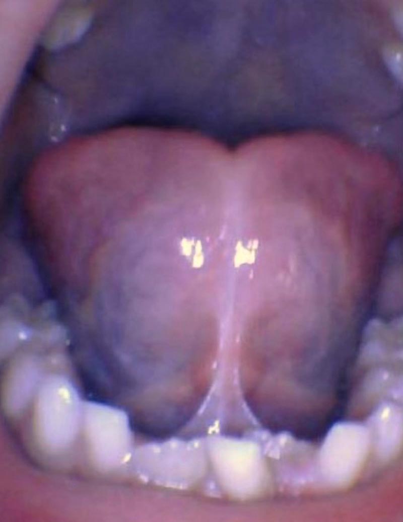 Release tongue ties laser technology tongue ties child tongue tie 3