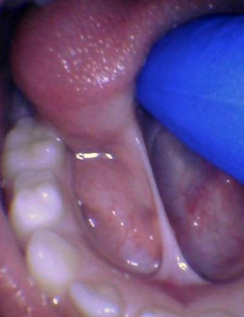 Release tongue ties laser technology tongue ties child tongue tie 2