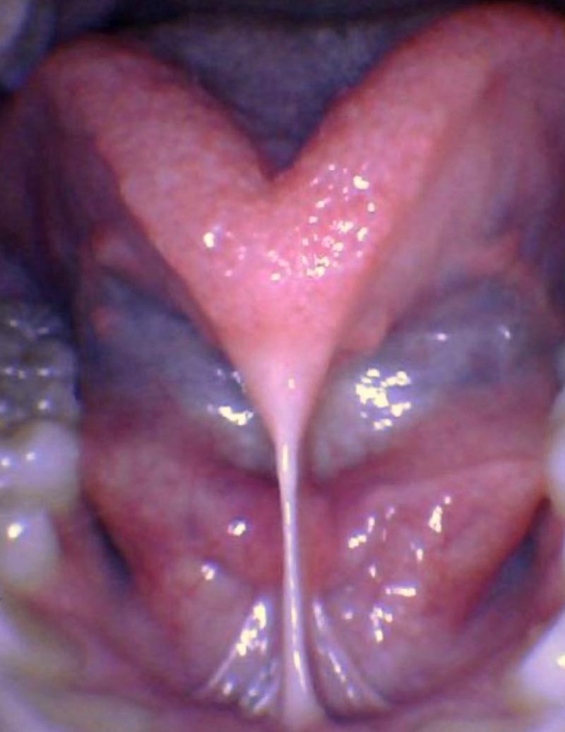 Release tongue ties laser technology tongue ties child tongue tie 1