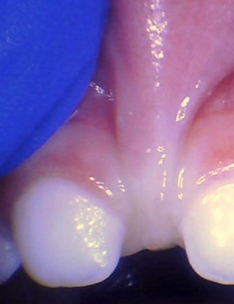 Release tongue ties laser technology tongue ties child lip tie 2