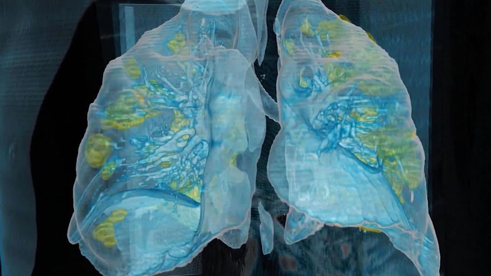Covid-hypoxia