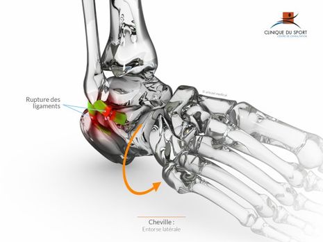 Cheville entorse -c2036