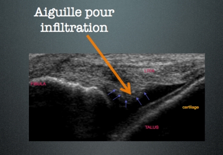 Conflit anterieur 4-3d291