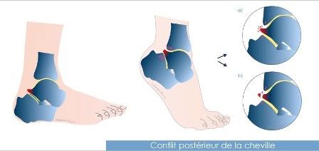 Conflit posterieur 1-d4ecc