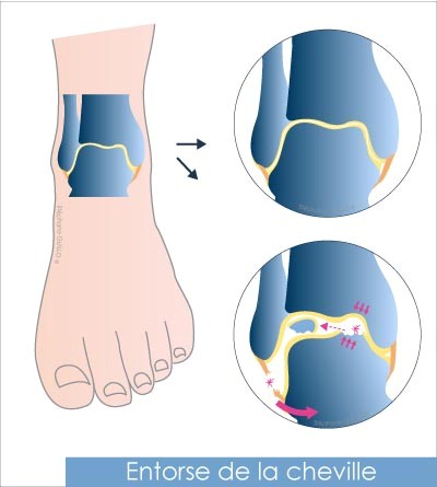 Chirurgie du Sport Bordeaux M rignac Entorses de cheville