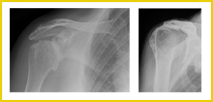 Arthrose-0afef-646af