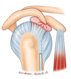Conflit sous acromial web-8484e