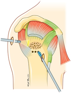Suture1 web-020af