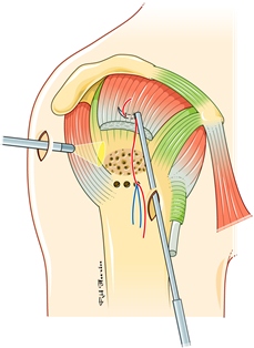 Suture2 web-ef5be