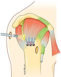 Suture3 web-a18dd